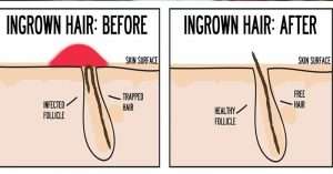 What You Should Know About Ingrown Hairs Nude Waxing