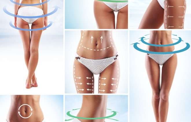 How to Lose Fat Without Exercise: Cellulite and Fat Reduction with VelaShape