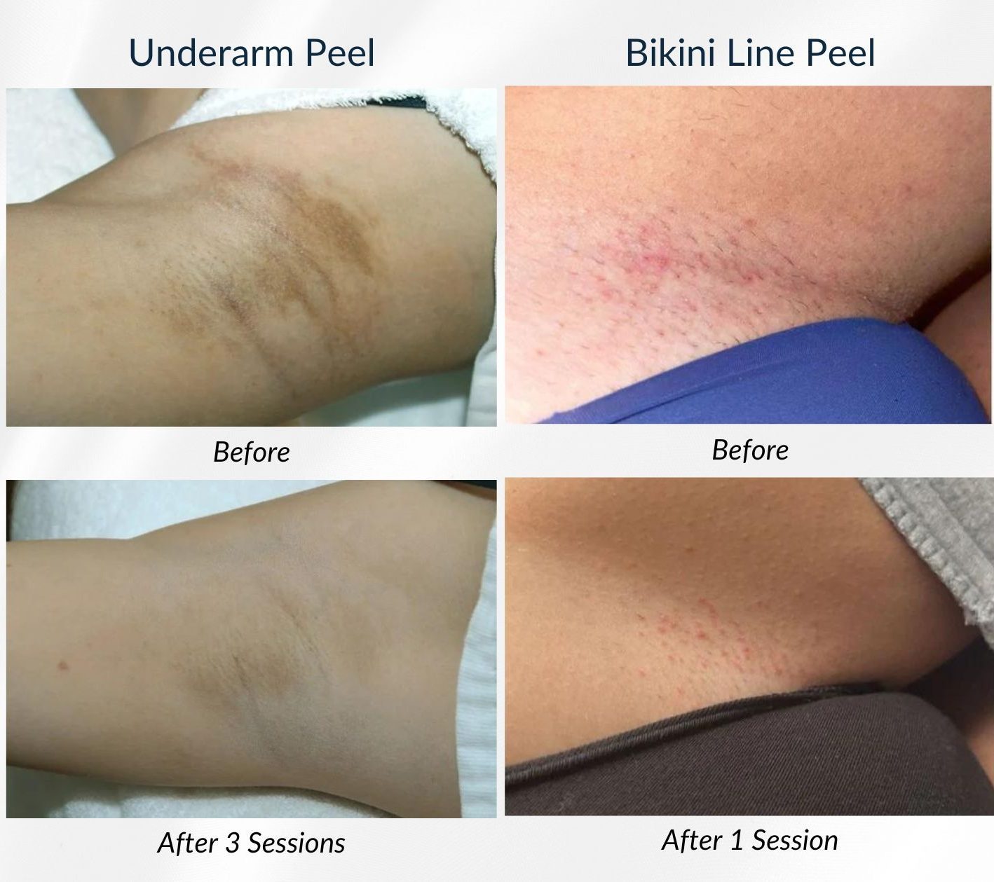 Brightening for your Underarm Bikini Area Nude Waxing